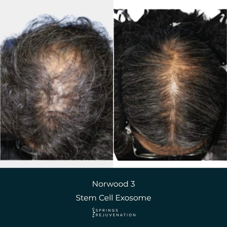 Norwood 3 Stem Cell Exosome